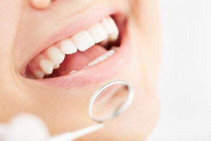 Why Oral Prophylaxis is Essential for Your Dental Health